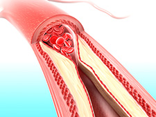 Cholesterol zatykający przepływ krwi